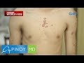 Keloid ng isang binata, kumalat daw mula sa dibdib hanggang binti?! | Pinoy MD