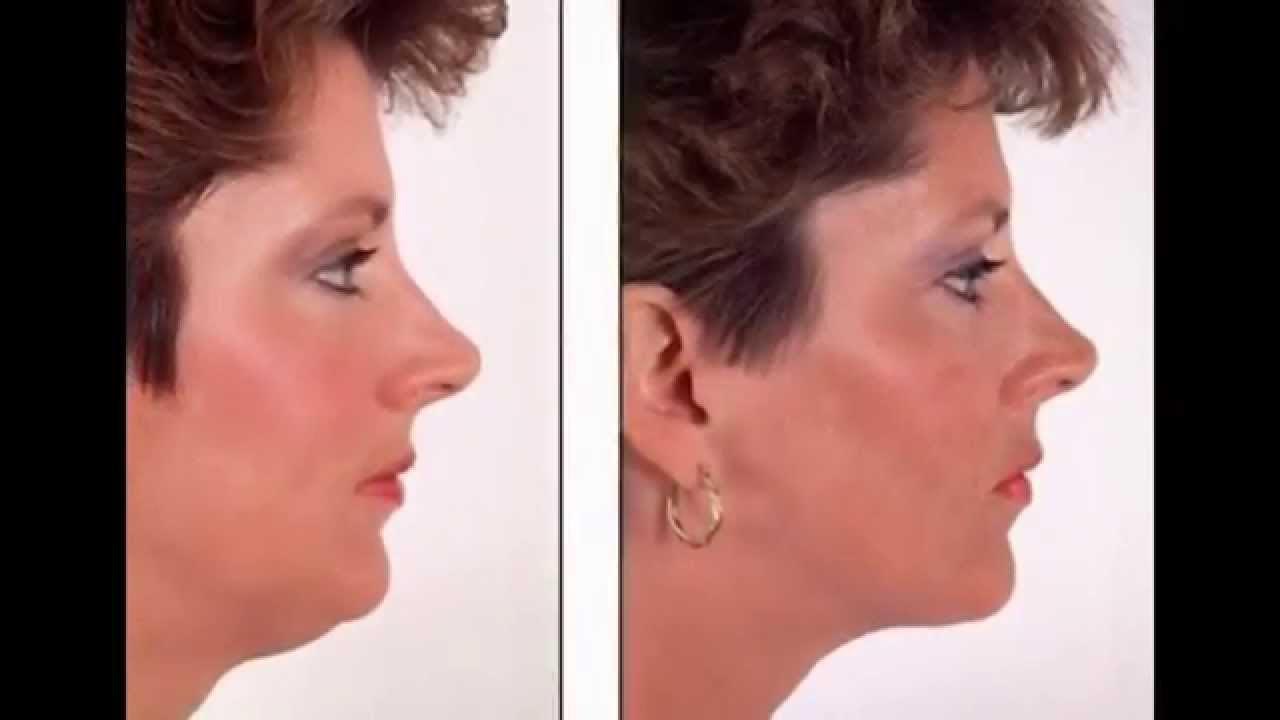 двойной подбородок. двойной подбородок. женщина в профиль. второй подбородок после 40 у женщины. как избавиться от 2 подбородка.