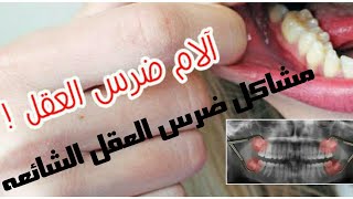 مشاكل ضرس العقل المدفون(impacted wisdom teeth)