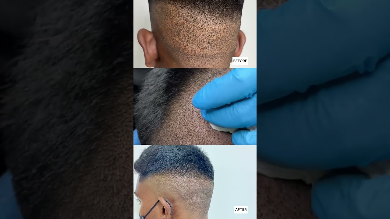 Healed FUE Scar camouflage,wow 😍 scalp micropigmentation 