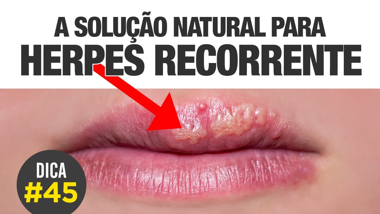HERPES RECORRENTE? Esse tratamento pode lhe ajudar [DICA #45] 👉👄 - YouTube