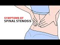 Symptoms of Spinal Stenosis