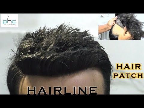 Hair transplant which celebrity has a hair transplant