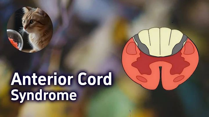 USMLE/UWorld - Anterior Spinal Artery Syndrome, Anterior Spinal Cord Syndrome, USMLE Step 1 review