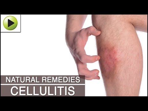 Video: Cellulitis Home Treatment: Heilmittel Ohne Antibiotika, Warnzeichen