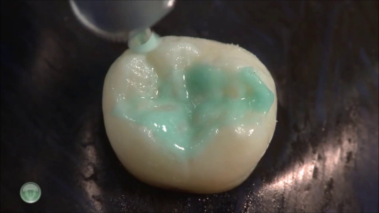 Ultradents UltraSeal XT hydro Procedure Video