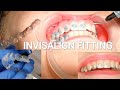 Invisalign Braces Fitting Appointment - Orthodontist Explains Each Step! (Including Attachments)