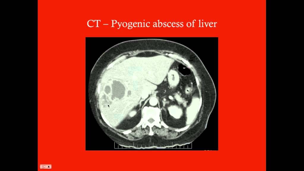 Liver Cysts And Abscesses Crash Medical Review Series Youtube