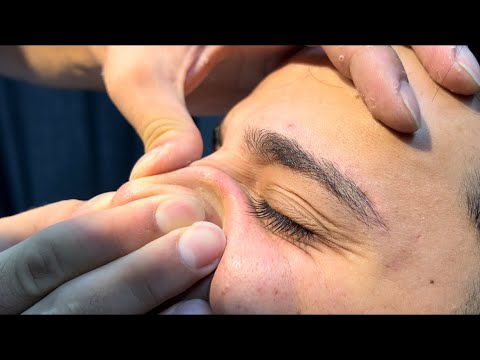 Blackhead and Acne Treatment ASMR Body Massage