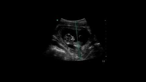 Measuring Fetal Heart Rate