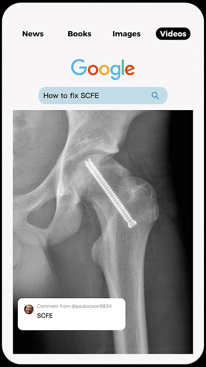 Slipped capital femoral epiphysis (SCFE) Hip Pain Relief #shorts