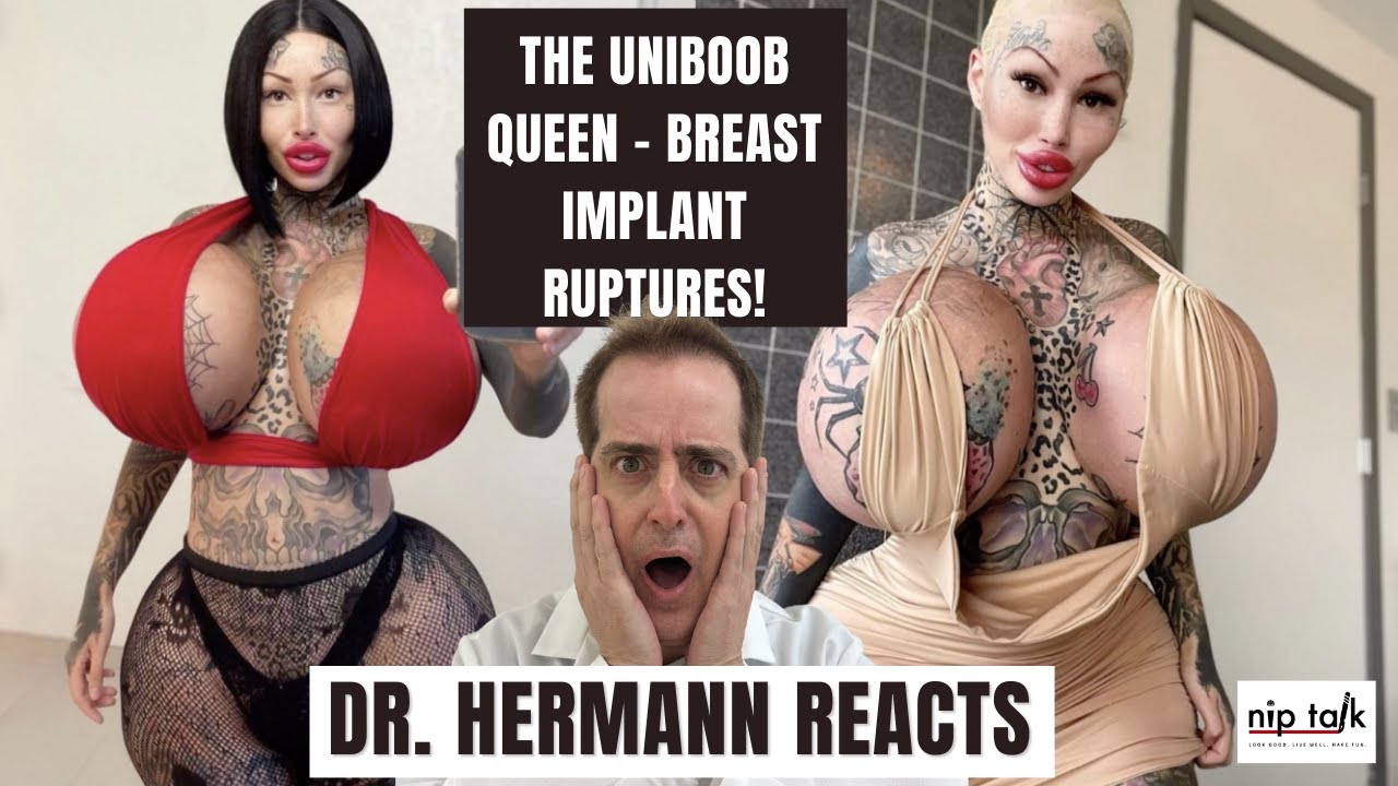 Only Fans Uniboob QUEEN Breast Implant Ruptures! 