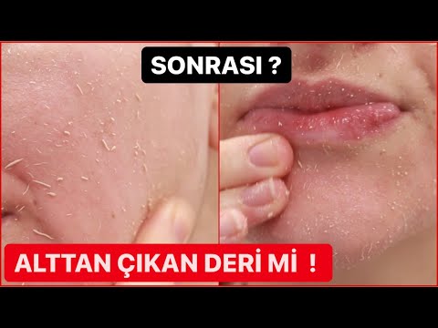 Video: Cilt Soyulmasından Kurtulmanın 3 Yolu