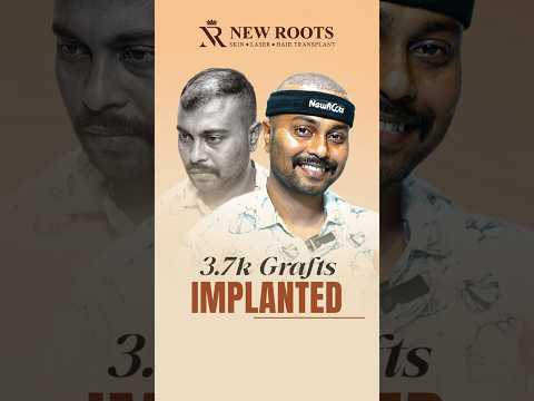 3700 Grafts Hair Transplant in Siliguri | Cost & Procedure #hairtransplant #siliguri #shorts