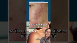 Let&#39;s talk about Post-Inflammatory Erythema