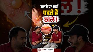 जलने पर क्यों पड़ते हैं छाले? जानिए वैज्ञानिक कारण! | Bihar Shila by MD Classes