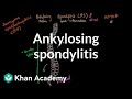 Ankylosing Spondylitis Quiz