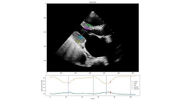 Deep Learning Prediction of Left Ventricular Dimensions, Screening for Cardiac Amyloidosis and HCM