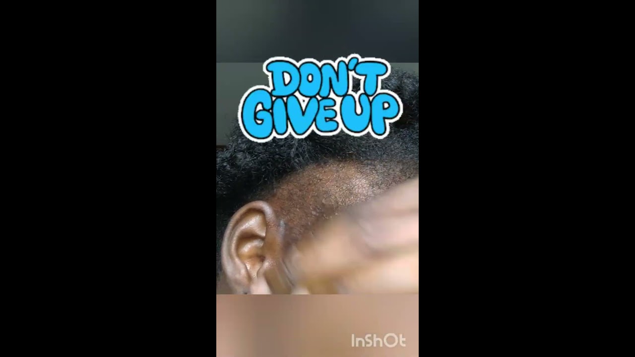  Will Onion Juice Regrowth Hair On My Bald Spot Day 25