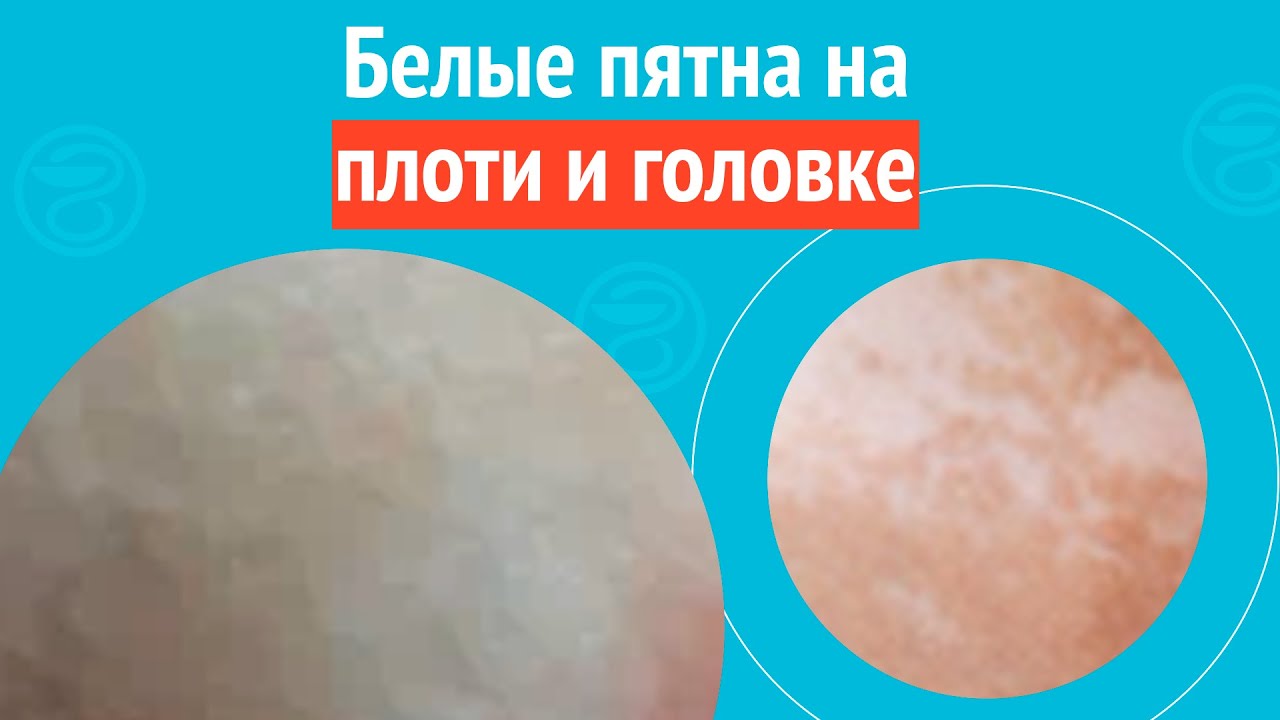 ➡️ Белые пятна на плоти и головке. Клинический случай № 1720