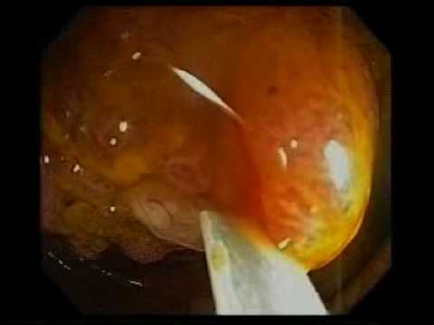 ASGE Learning Video Sample - Colonoscopy Polypectomy
