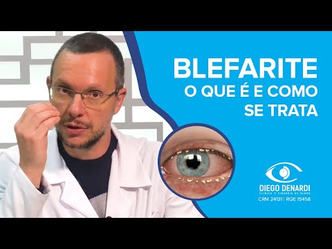BLEFARITE: A inflamação das pálpebras | Dr. Diego Denardi | 2020
