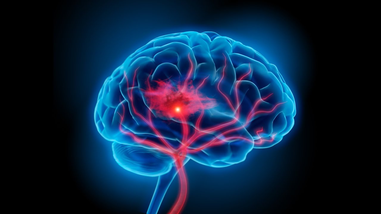 neurocirugía bogota Infarto, edema y muerte cerebral