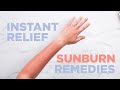 Instant relief sunburn remedies
