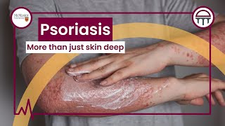 Psoriasis: More than just a rash