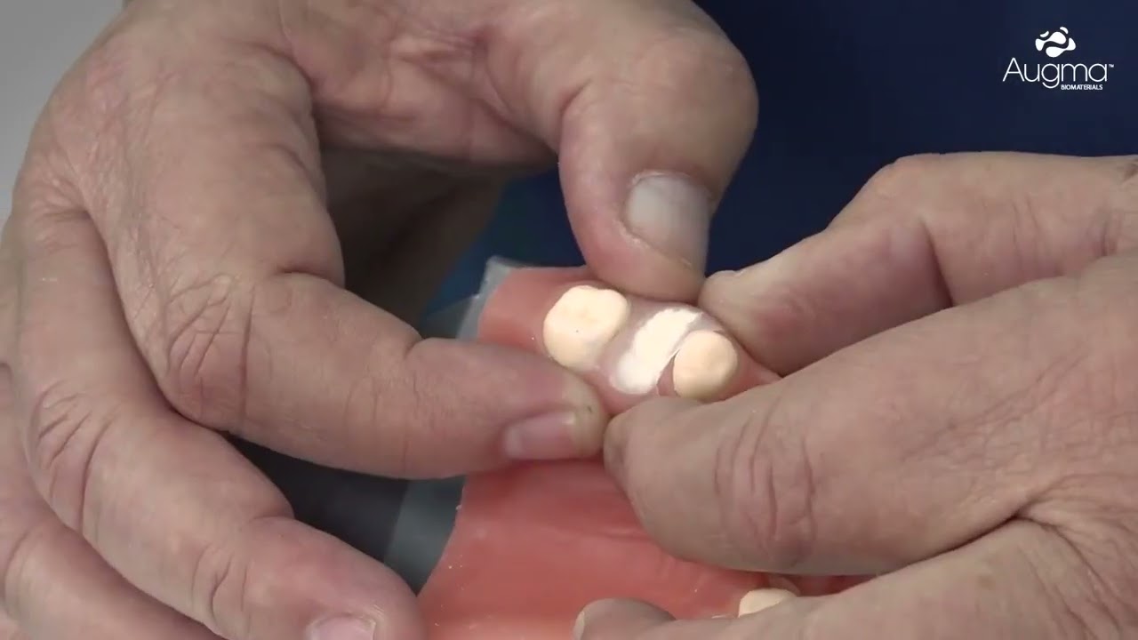 3D Bond+™ & Augma Shield™ Training Video- www.biofix.pt