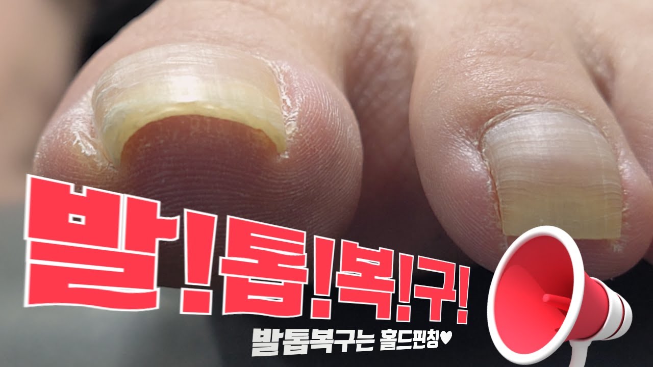 [특허관리] 구부러져 살을 찌르는 발톱 관리하기 / How to fix a Curved Nail (eng sub) 내성발톱