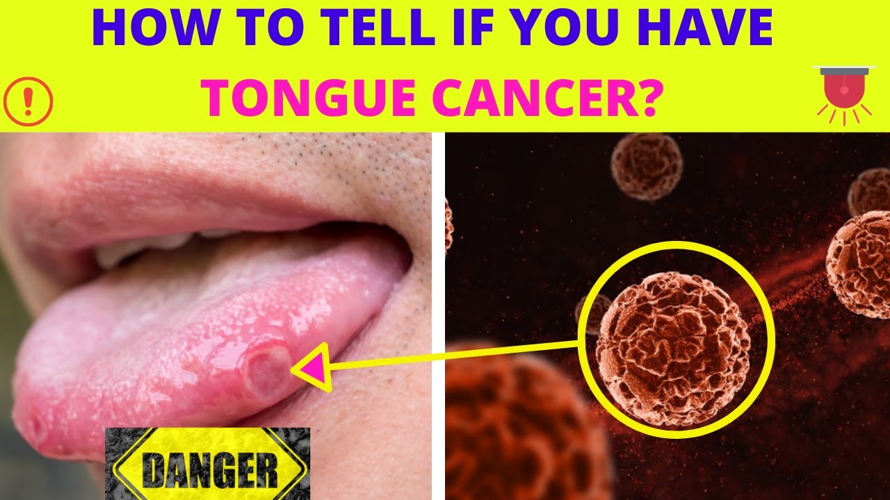 Early Signs And Symptoms Of Tongue Cancer How To Tell If You Have