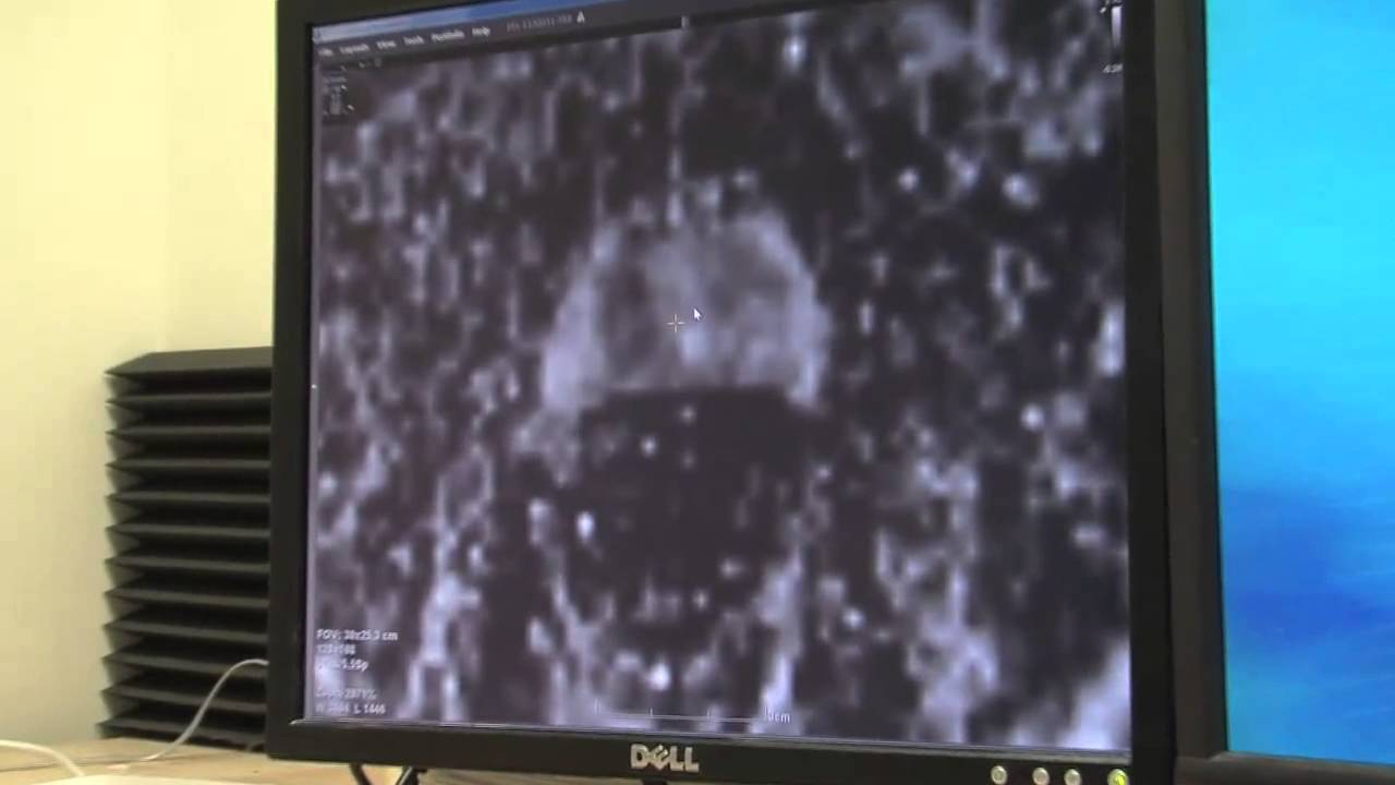 (1) Prostate Biopsies Guided by MR-US Image Fusion