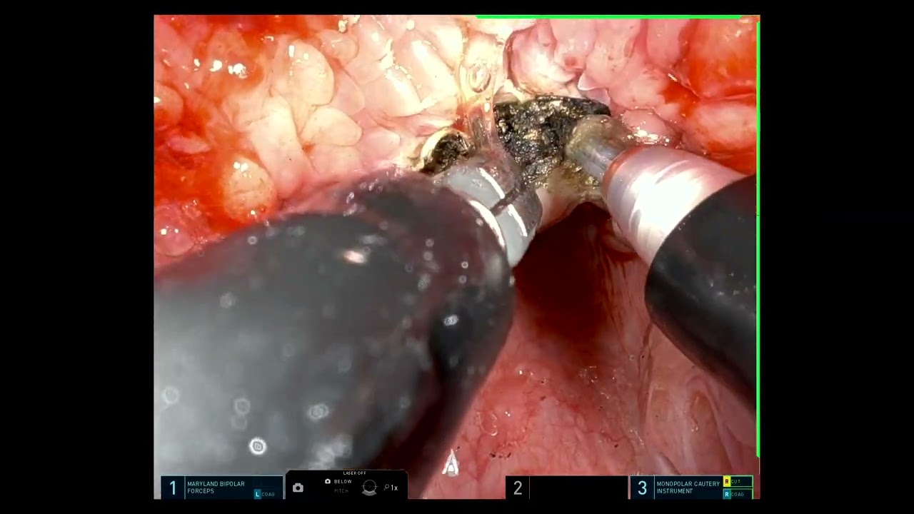 TransOral Robotic Lingual Thyroidectomy, Sp Robot
