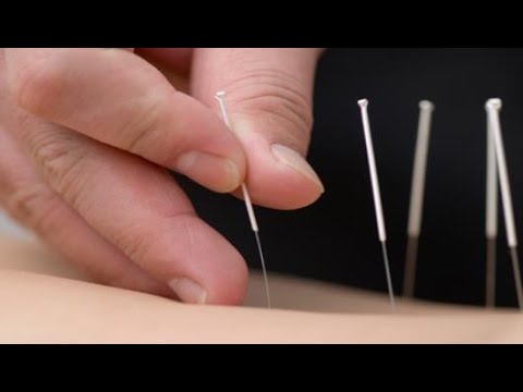 Video: Akupunktur För Depression: Fungerar Det Verkligen? Och 12 Andra Vanliga Frågor