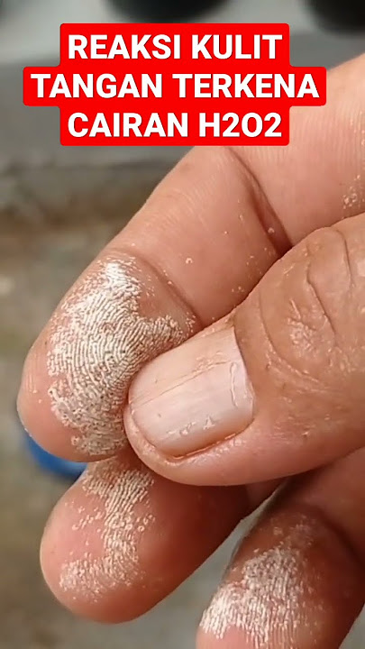 REAKSI KULIT JARI TANGAN TERKENA CAIRAN H2O2 50% TANAMAN