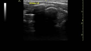 Chapter 22 - Longitudinal image of the airway
