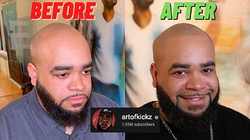 WOW YouTube Star artofkickz gets SCALP MICROPIGMENTATION