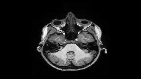 5 sub CH8410a ses 20130307 acq mprage run 01 B4 T1w