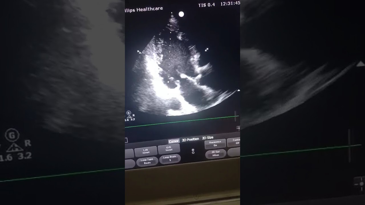 Neglected MI, markedly impaired LV systolic function and basal inferior wall aneurysm