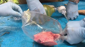 Demonstration of Tension Pneumothorax and Finger Thoracostomy