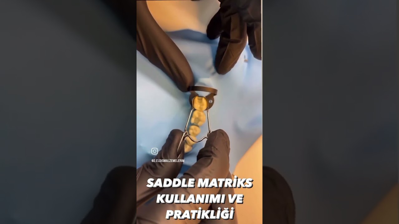 sectional contoured matrix band 