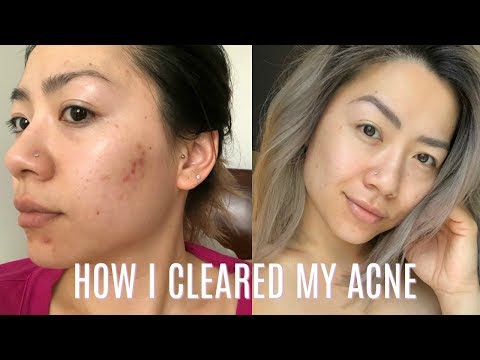 The Skincare Routine that Cleared My Acne and Skin for GOOD!