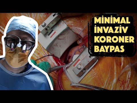 Video: Bypass Ameliyatına Nasıl Hazırlanılır: 12 Adım (Resimli)
