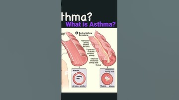 What is Asthma   How does it affect the lungs   Link to video in description!
