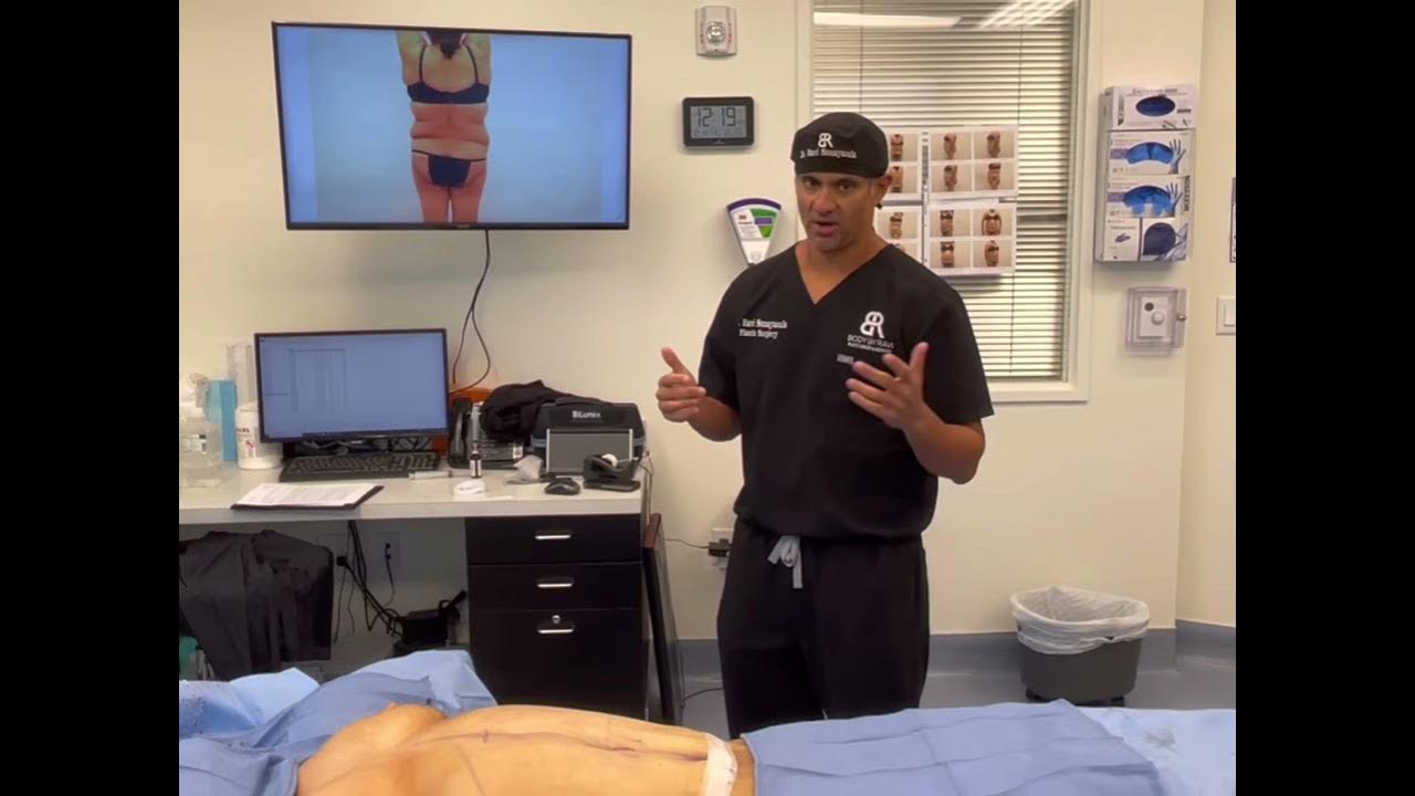 What is Dr. Ravi's World Renowned SMART Tummy Tuck? Learn more about this  amazing procedure. 