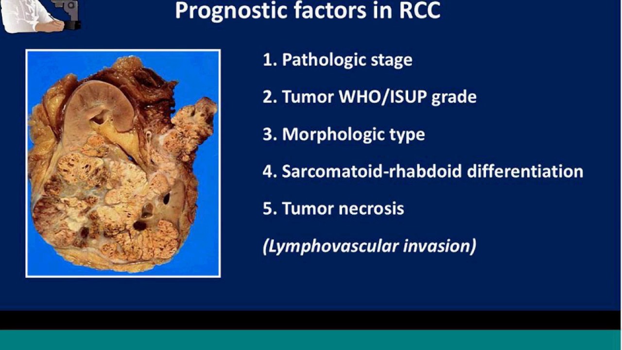 CAP education session Kidney cancer Dr Trpkov 2018