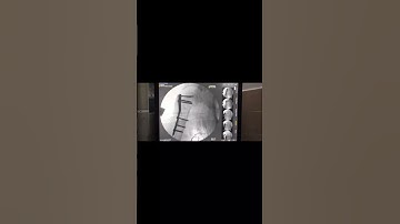 PROXIMAL HUMERUS FRACTURE. INTERNAL LOCKED SYSTEM ( Philos Plate ).Dr Ariful islam ( MS Ortho).