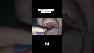 Amigdalas sanas despues del tratamiento