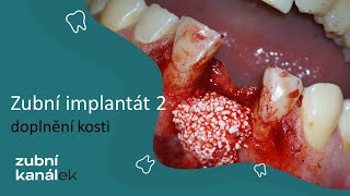 Zubní implantát - doplnění kosti, augmentace, sinus lift, dotazy